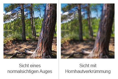 Hornhautverk mmung Astigmatismus 