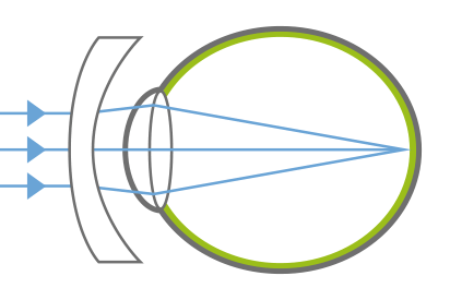 Myopie - Auge mit Korrekturglas
